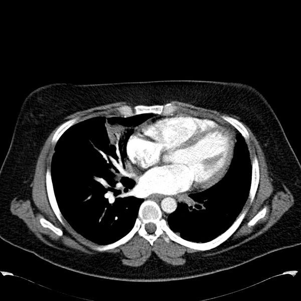 File:Chronic thromboembolic pulmonary hypertension (CTEPH) (Radiopaedia 74597-85531 Axial C+ CTPA 30).jpg