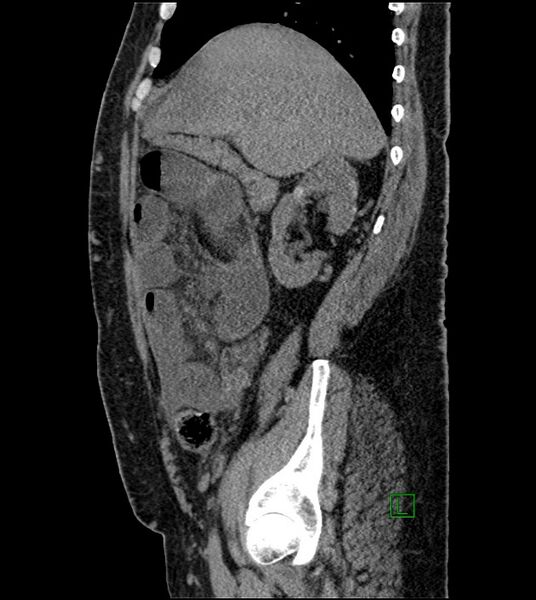 File:Closed-loop small bowel obstruction-internal hernia (Radiopaedia 78439-91096 C 102).jpg