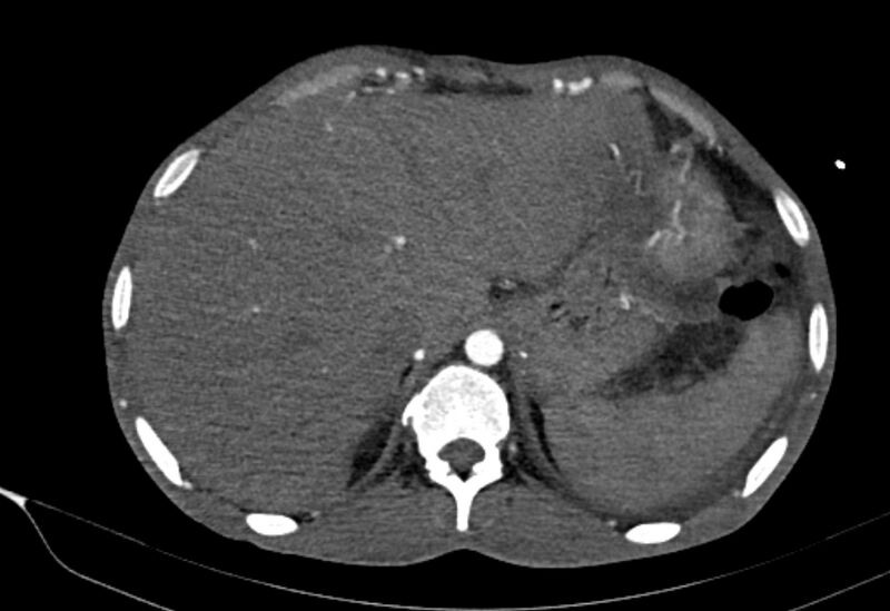 File:Coarctation of aorta with aortic valve stenosis (Radiopaedia 70463-80574 A 220).jpg