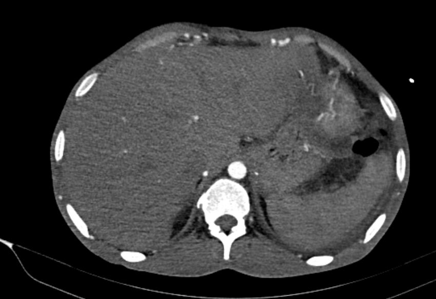 Coarctation of aorta with aortic valve stenosis (Radiopaedia 70463-80574 A 220).jpg