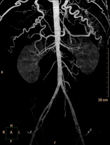 File:Coarctation of the aorta (Radiopaedia 27458-27657 3D 11).jpg