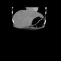 Colocolic fistula - Crohn disease (Radiopaedia 57063-63955 B 2).jpg
