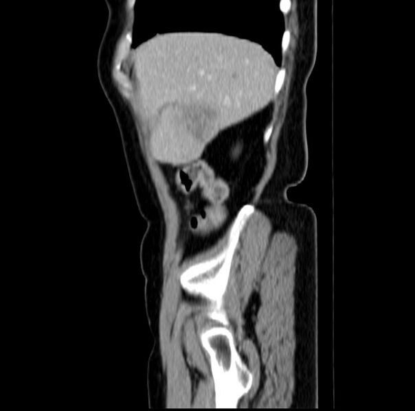 File:Colon carcinoma with hepatic metastases (Radiopaedia 29477-29961 C 9).jpg