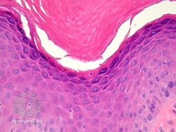 Inflammatory linear verrucous epidermal nevus-pathology