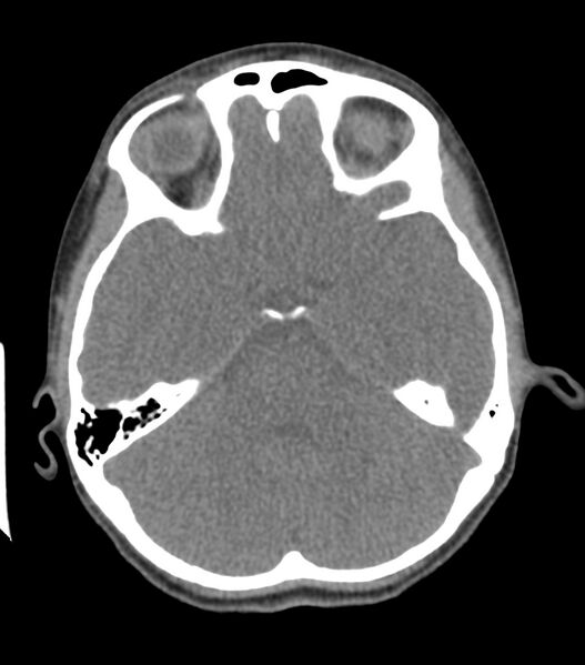 File:Nasoorbitoethmoid fracture (Radiopaedia 90044-107205 Axial non-contrast 177).jpg