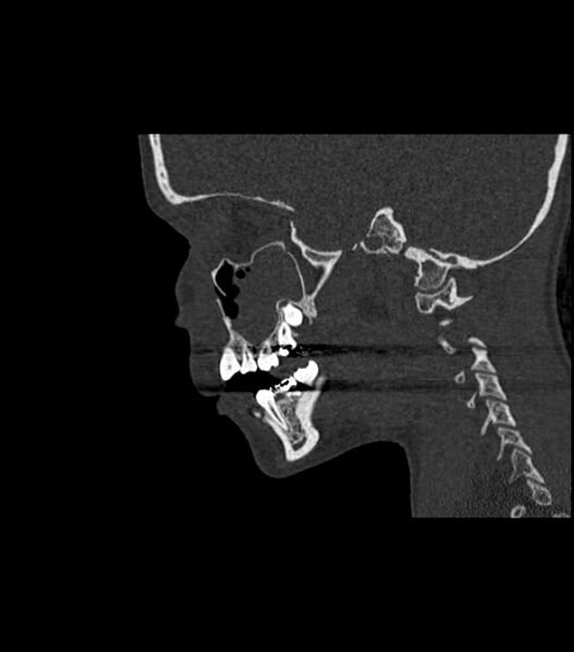 File:Nasoorbitoethmoid fracture (Radiopaedia 90044-107205 Sagittal bone window 93).jpg