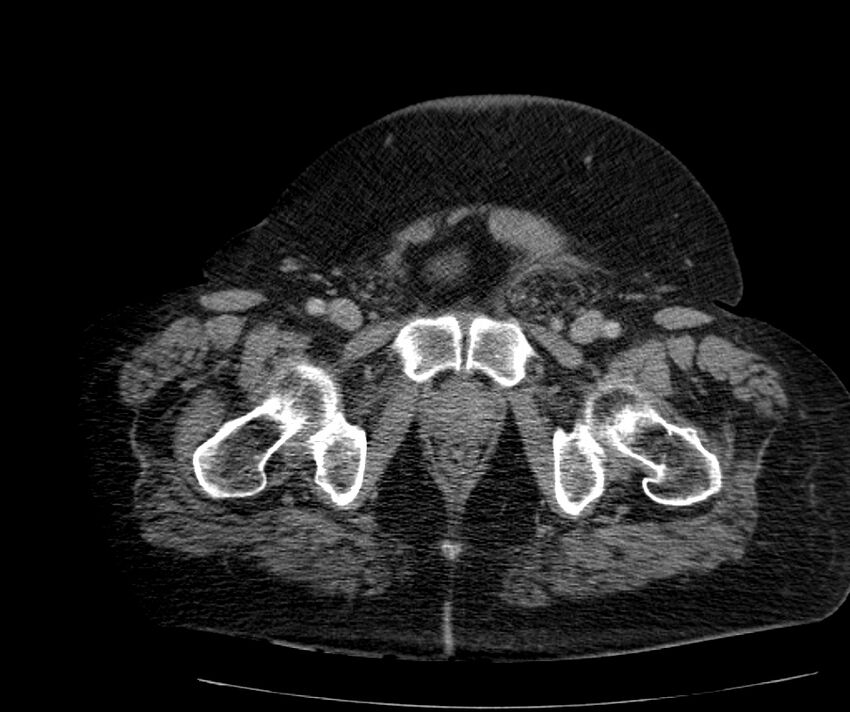 Nephroptosis with inguinal hernia containing perirenal fat (Radiopaedia 56632-63391 C 328).jpg