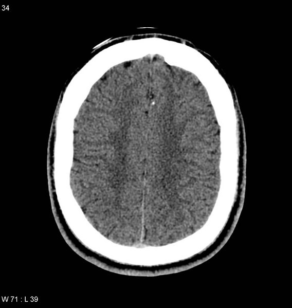 File:Neurocysticercosis (Radiopaedia 4767-6772 B 1).jpg