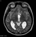 Neurofibromatosis type 2 - cranial and spinal involvement (Radiopaedia 5351-7111 Axial T2 12).jpg