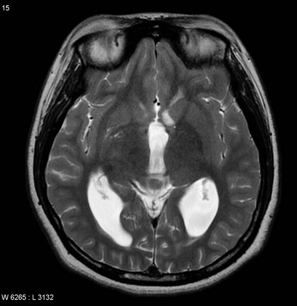 File:Neurofibromatosis type 2 - cranial and spinal involvement (Radiopaedia 5351-7111 Axial T2 12).jpg