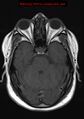 Neuroglial cyst (Radiopaedia 10713-11184 Axial T1 16).jpg