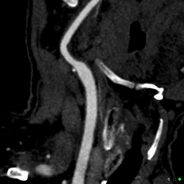 File:Non-occlusive intraluminal internal carotid artery thrombus (Radiopaedia 37751-39658 C 29).jpg