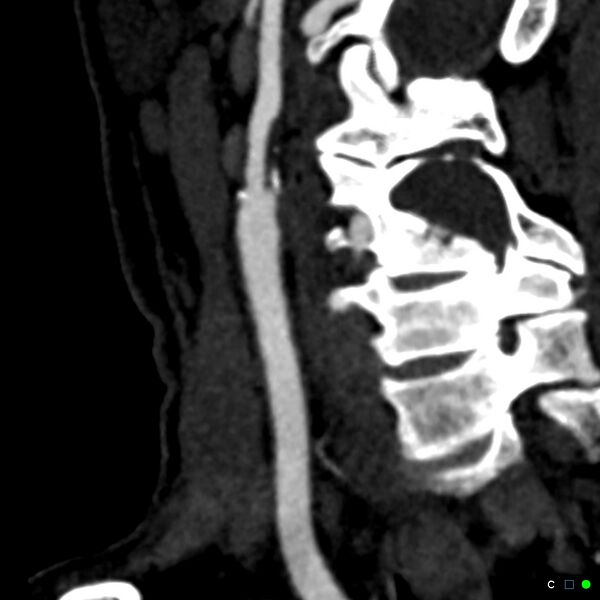 File:Non-occlusive intraluminal internal carotid artery thrombus (Radiopaedia 37751-39658 C 41).jpg