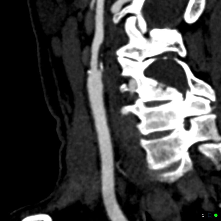 Non-occlusive intraluminal internal carotid artery thrombus (Radiopaedia 37751-39658 C 41).jpg