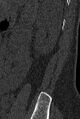 Normal CT lumbar spine (Radiopaedia 53981-60118 Sagittal bone window 97).jpg
