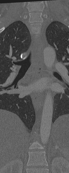 File:Normal CT thoracic spine (Radiopaedia 40181-42688 Coronal bone window 21).png