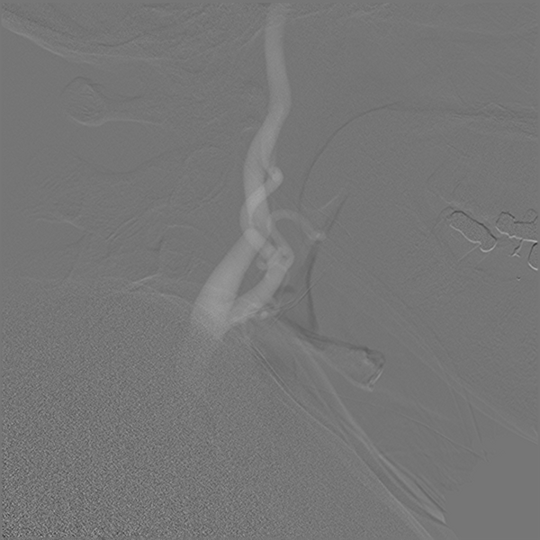 File:Normal cerebral angiogram (four vessel DSA) (Radiopaedia 41708-44649 C 6).png