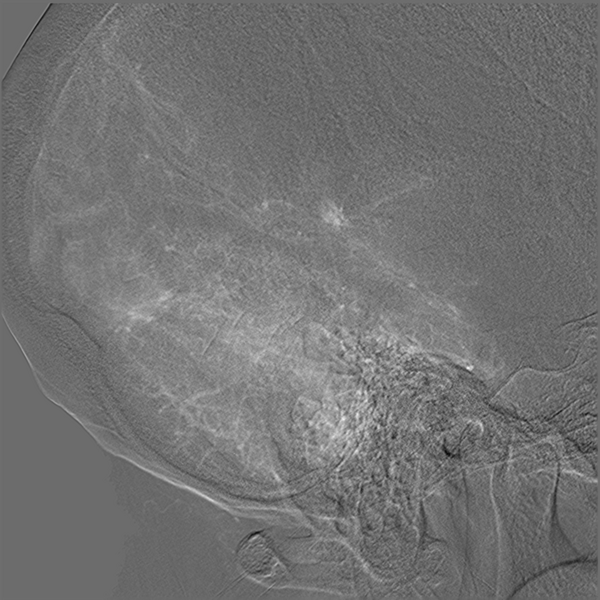 File:Normal cerebral angiogram (four vessel DSA) (Radiopaedia 41708-44649 R 16).png