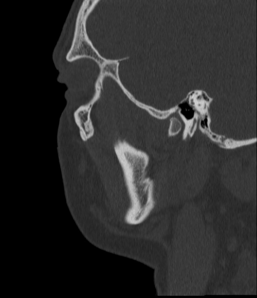 Normal facial bone CT (Radiopaedia 88742-105476 Sagittal bone window 43).jpg