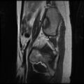 Normal female pelvis MRI (retroverted uterus) (Radiopaedia 61832-69933 Sagittal T2 29).jpg