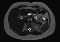 Normal liver MRI with Gadolinium (Radiopaedia 58913-66163 E 20).jpg