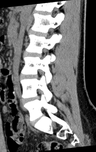 File:Normal lumbar spine CT (Radiopaedia 46533-50986 C 42).png