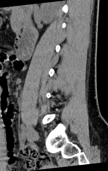 File:Normal lumbar spine CT (Radiopaedia 46533-50986 C 72).png