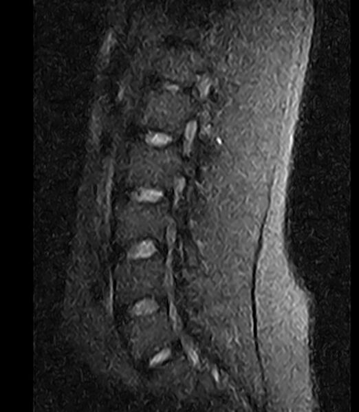 File:Normal lumbar spine MRI - low-field MRI scanner (Radiopaedia 40976-43699 Sagittal STIR 4).jpg