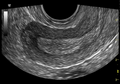 Normal pelvic ultrasound - transvaginal (Radiopaedia 31750-32684 C 1).png