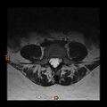 Normal spine MRI (Radiopaedia 77323-89408 Axial T2 18).jpg
