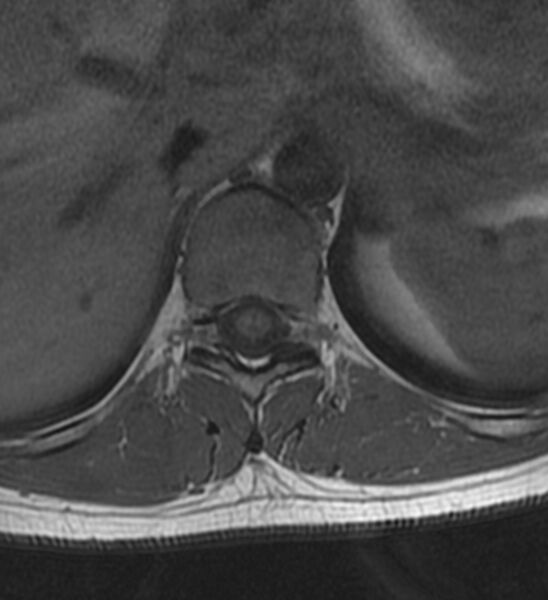 File:Normal thoracic spine MRI (Radiopaedia 41033-43781 Axial T1 18).jpg