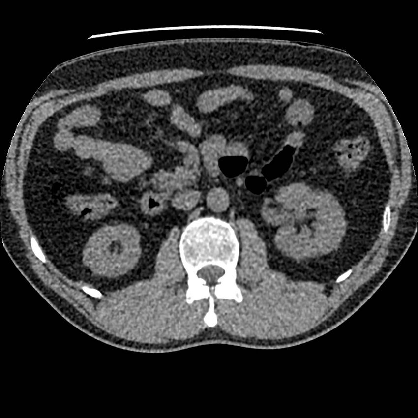 Obstructing ureteric calculus and ureteric anatomy (Radiopaedia 62730-71042 Axial non-contrast 44).jpg