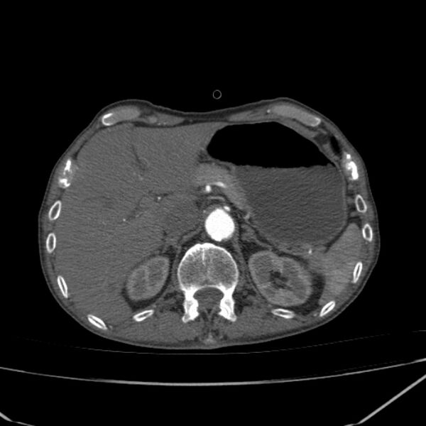 File:Abdominal aortic aneurysm (Radiopaedia 23703-23856 Axial C+ arterial phase 14).jpg