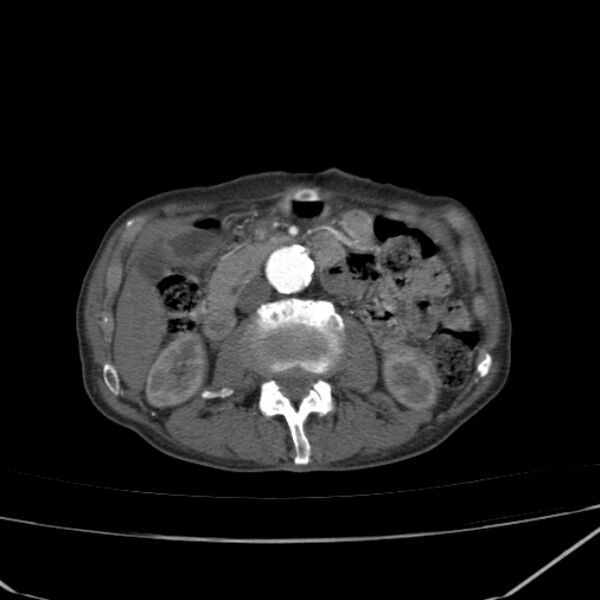 File:Abdominal aortic aneurysm (Radiopaedia 23703-23856 Axial C+ arterial phase 35).jpg
