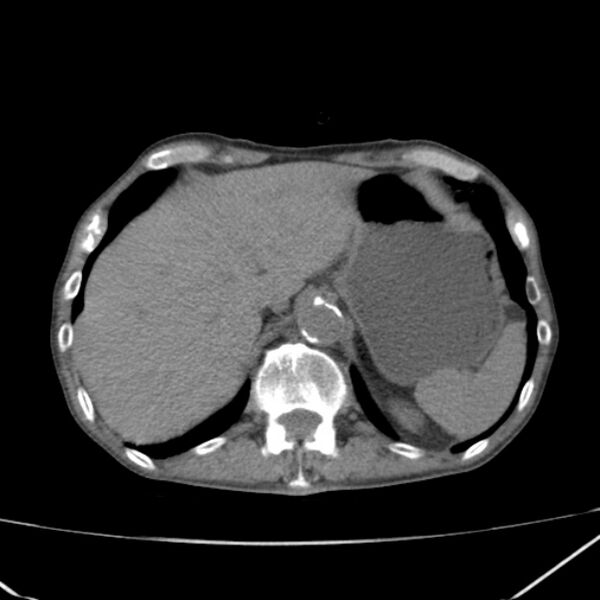 File:Abdominal aortic aneurysm (Radiopaedia 23703-23856 Axial non-contrast 10).jpg