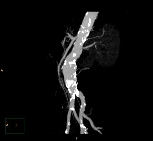 File:Abdominal aortic aneurysm (Radiopaedia 23703-23856 MIP 21).jpg