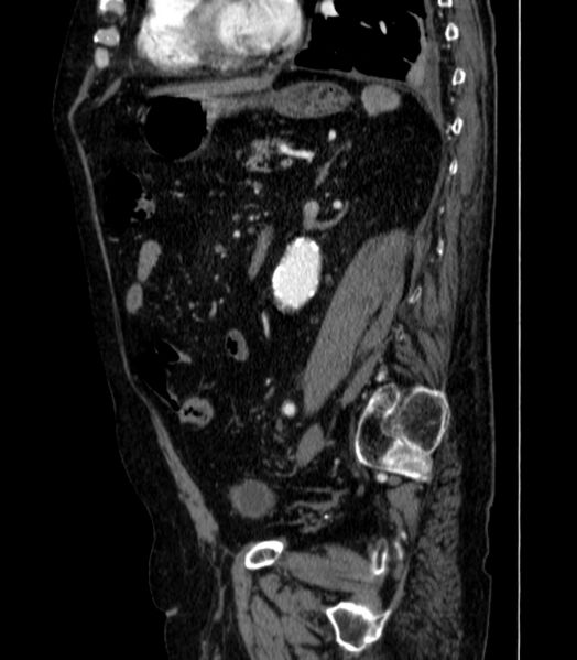 File:Abdominal aortic aneurysm (Radiopaedia 25855-26001 Sagittal C+ arterial phase 43).jpg