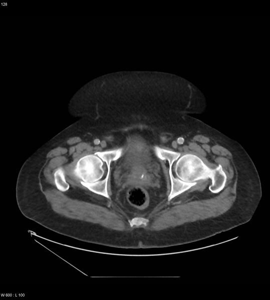 File:Abdominal aortic aneurysm with intramural hematoma then rupture (Radiopaedia 50278-55631 Axial C+ arterial phase 119).jpg