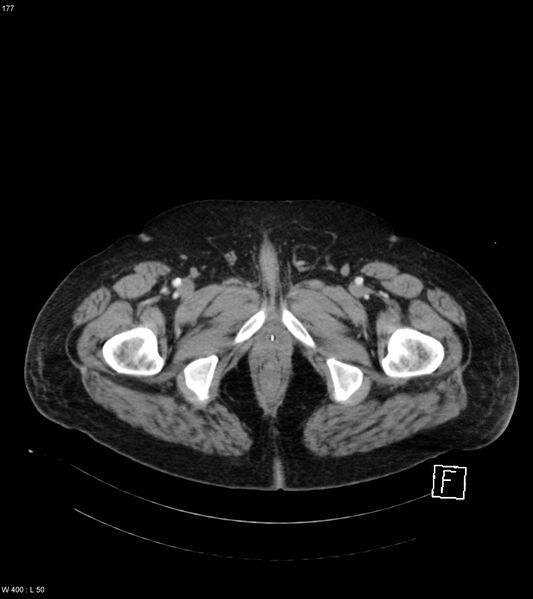 File:Abdominal aortic aneurysm with intramural hematoma then rupture (Radiopaedia 50278-55632 Axial C+ arterial phase 176).jpg