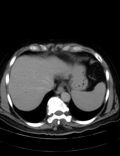 File:Abdominal lymphoma - with sandwich sign (Radiopaedia 53486-59492 Axial C+ portal venous phase 6).jpg