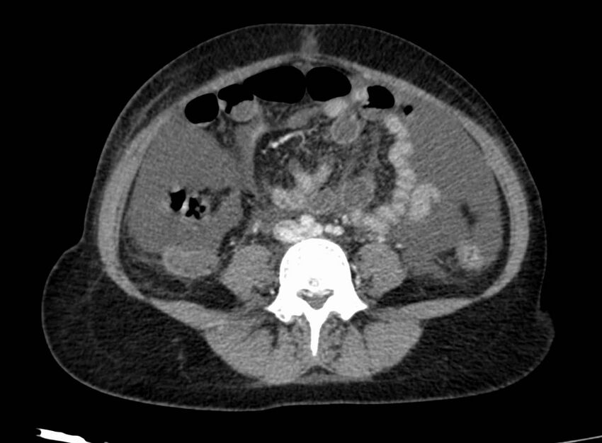 Acute Budd-Chiari syndrome (Radiopaedia 60858-68638 Axial C+ portal venous phase 188).jpg