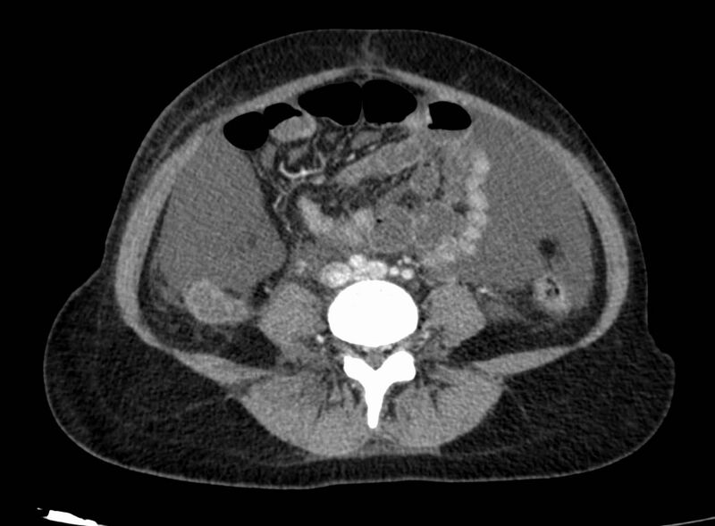 File:Acute Budd-Chiari syndrome (Radiopaedia 60858-68638 Axial C+ portal venous phase 192).jpg