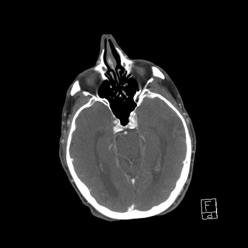 Acute ICA ischemic penumbra due to high-grade CCA stenosis (CT perfusion) (Radiopaedia 72038-82530 Axial C+ arterial phase 10).jpg