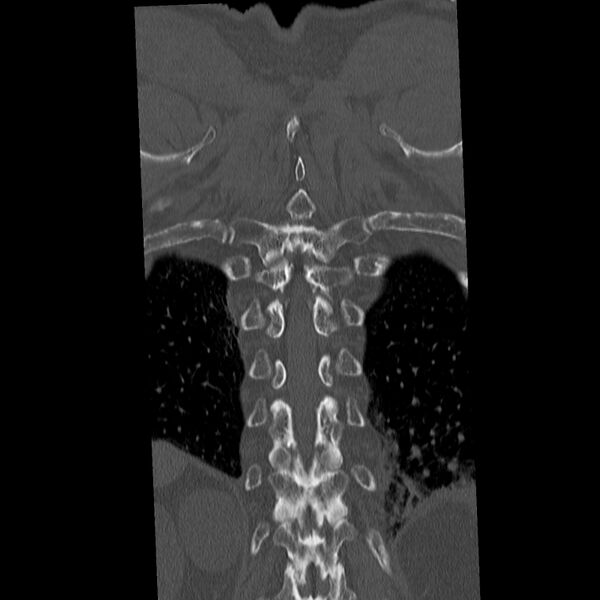 File:Acute and chronic vertebral compression fractures (Radiopaedia 31608-32494 Coronal bone window 39).jpg