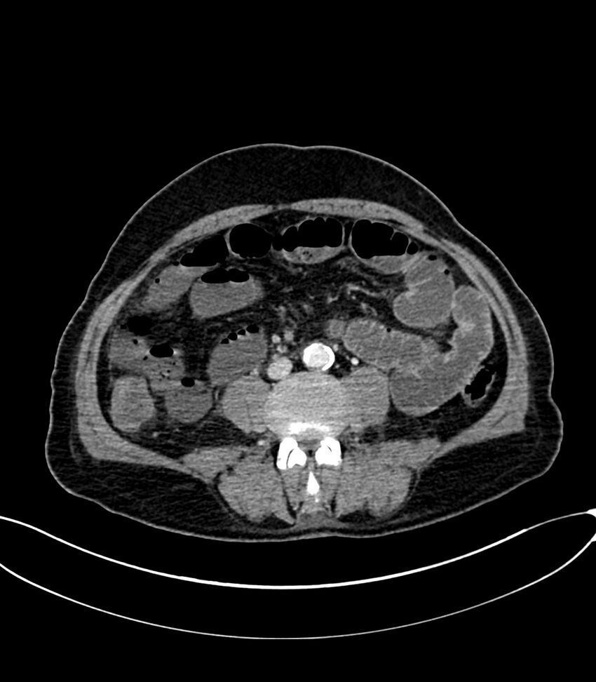 Acute arterial mesenteric ischemia (Radiopaedia 78238-90828 Axial C+ portal venous phase 79).jpg