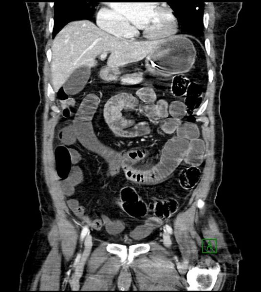 File:Acute arterial mesenteric ischemia (Radiopaedia 78238-90828 Coronal C+ portal venous phase 39).jpg
