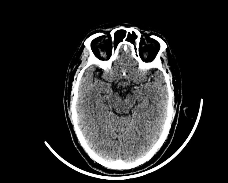 File:Acute cerebral infarct (Radiopaedia 35604-37123 Axial non-contrast 39).jpg
