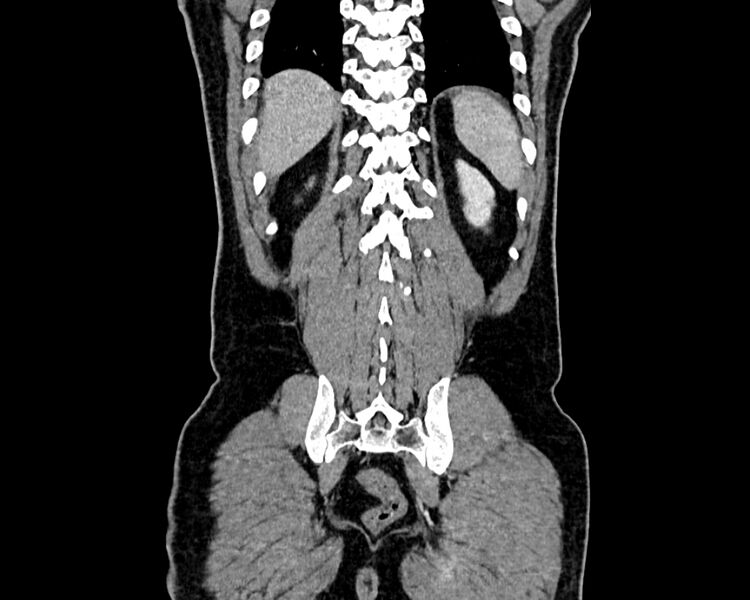 File:Acute cholecystitis (Radiopaedia 53216-59182 Coronal C+ portal venous phase 16).jpg