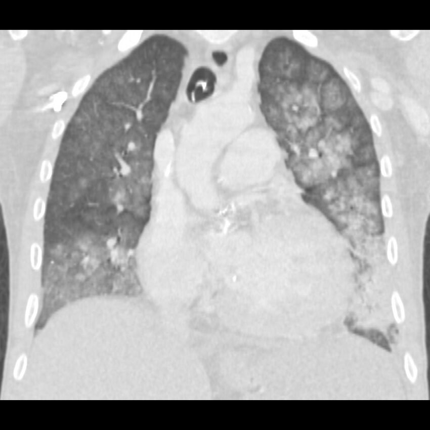 Acute diffuse alveolar hemorrhage (Radiopaedia 41323-44158 Coronal lung window 21).jpg