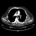 Acute heart failure (CT) (Radiopaedia 79835-93075 Axial C+ arterial phase 9).jpg